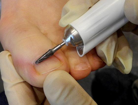 Behandlung der Nägel mittels Fräser